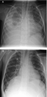 (A) Right-sided phrenic nerve paralysis in a 4.2-year-old boy with chronic ascites and pleural effusions 1 year after extracardiac conduit Fontan operation. The mean pulmonary artery pressure 9 months after surgery was 13mmHg. (B) Significant augmentation of the lung volume on the affected side after diaphragm plication. Disappearance of ascites and effusions was observed within the following weeks. Four years after ECFO the patient is doing very well and shows normal somatic development.