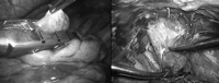 Apical bullectomy performed with purposely designed endoscopic staplers (left). Apical parietal pleurectomy (right).