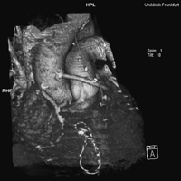 Patent aortic connector in three-dimensional reconstruction.