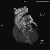 Occluded graft with aortic connector in three-dimensional reconstruction.