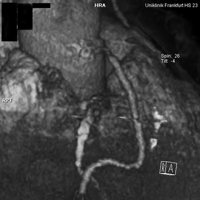 Fifty-percent stenosis of a graft with aortic connector in three-dimensional reconstruction.