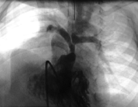 Preoperative right ventricular angiogram of patient. Hypoplastic central pulmonary arteries.
