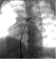 Position of the stents in the pulmonary arteries 2 months after implantation in the same patient.