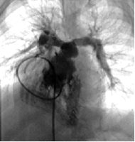 Angiogram of the stented pulmonary arteries 2 months after stent implantation in the same patient.