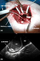 (a) The A-MVSDO completely opened connected with delivery cable through the substernal incision (18F sheath—external diameter 8mm). (b) IVUS echocardiogram showing the A-MVSDO completely opened on the LV wall.