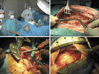 (A) The left sternum is lift and the LITA is harvested when the patient breaths spontaneously. (B) The LITA is harvested from the sixth side branch until the first branch. Double clips are used to cut side branches. (C) LITA-LAD anastomosis is performed with a mechanin stabilizator. (D) The LITA-LAD anastomosis trough partial sternotomy and limited pericardiectomy.