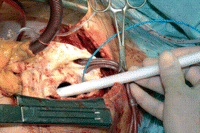 Introduction of the delivery system carrying the hybridprosthesis into the descending aorta of a patient with a combined aortic arch and descending aortic aneurysm. The aortic arch is opened during hypothermic circulatory arrest. Catheters for selective antegrade cerebral perfusion are placed in the brachiocephalic trunk and the left common carotid artery. A Fogarty catheter blocks the origin of the left subclavian artery to prevent back bleeding.