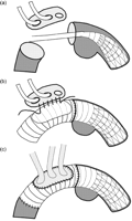 (a) The stented end of the hybridprosthesis is deployed in the descending aorta distal of the dilated segment. Selective antegrade cerebral perfusion is accomplished during hypothermic circulatory arrest. (b) After suturing the hybridprosthesis circumferentially into the descending aorta directly distal the origin of the left subclavian artery, the supraaortic branches are reimplanted into the graft as a single tissue patch. (c) The reconstruction may then be completed at any desired level of the ascending aorta while cardiopulmonary bypass is reestablished.
