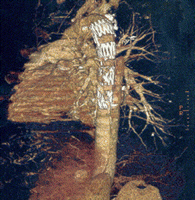 CT reformation of a patient with chronic aortic dissection type A, 25 months following implantation of a hybridprosthesis. The proximal segment of the false lumen covered by the stented segment of the hybridprosthesis is thrombosed.