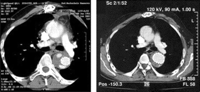 (a,b) Contrast CT-scans of a patient with a chronic aortic dissection type A following implantation of a hybridprosthesis 1 week (left panel) and 10 months (right panel) postoperatively. Perigraft space around the stented segment of the hybridprosthesis in the descending aorta is thrombosed partially at 1 week postoperatively (left panel). At 10 months postoperatively the perigraft space is thrombosed completely. The diameter of the stented segment of the hybridprosthesis became wider when compared to 1 week postoperatively after complete unfolding of the stent. Compared to the status 1 week postoperatively, the diameter of the aneurysm in the descending aorta is now reduced.