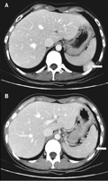 Computed tomography scan of thorax showing a homogenously enhanced mass with central feeding vessel bordering the diaphragm and the parietal pleura (A). Note a cord-like enhanced structure underneath the diaphragm, which was the vascular pedicle (B).
