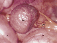 A round bluish-red colored mass and fatty mesenteric pedicle (thoracoscopic view). AS, accessory spleen; VP, vascular pedicle; D, diaphragm; H, heart.