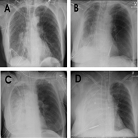 Four examples of chest radiographs with diffuse infiltrates classified as (A) minimal—diffuse infiltrate only, (B) mild—diffuse infiltrate with areas of consolidation (≪50% parenchymal involvement), (C) moderate—diffuse infiltrate with consolidation (≥50% but less than 90% parenchymal involvement), and (D) severe—≥90% consolidation. An ‘infiltrate’ refers to opacity with visible underlying parenchymal structure. The term ‘consolidation’ refers to opacities whereby the underlying parenchymal structure could not be visualized. Accentuation of hilar structures (seen in over 90% of early radiographs) was not considered in this radiographic classification.