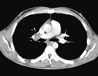 Axial chest CT view showing right hilar adenomegaly in relation with renal cell carcinoma metastasis.