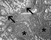 Hilar lymph node renal cell carcinoma metastasis (arrows). Lymph node is recognisable by follicular lymphoid tissue (*). (Hematoxylin eosin, ×200).