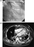 (A) Coronary angiography showing that the posterolateral (PL) artery of the circumflex coronary artery is totally occluded. (B) The chest enhanced multislice computed tomography (MSCT) shows that the lateral wall of the left ventricule is dissected (arrow).