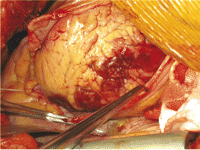 Operative findings showing necrotic myocardial tissue in the left ventricular lateral wall that was easy to expose through a lateral thoracotomy.