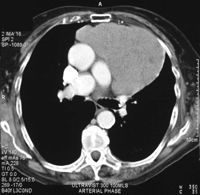 Computer tomogram demonstrating anterior mediastinal mass.