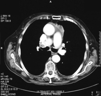 Computer tomogram 4 months later post glucocorticoid therapy.