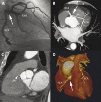 (A) Conventional angiography (RAO projection) of the single coronary artery with both the right and left coronary artery (RCA, LCA) originating from a single ostium (arrow). The left main segment (LMS) is a long transverse branch that crosses the base of the heart to the left side. However, the definite anatomic relationship between the left main segment and the great thoracic arteries remained unclear. (B–D) Contrast-enhanced ECG-gated 64-slice computed tomography (Panel B: maximum intensity projection; Panel C: multiplanar image reformation; Panel D: three-dimensional image reconstruction) demonstrating abnormal anatomic pattern of the coronary artery tree with a single ostium (arrows)). It became clearly evident that the left main segment courses between aortic root and pulmonary trunk (Panel C—arrowhead). This is an extremely rare type of coronary artery anomaly that has been described as potentially malignant, since a fall in coronary blood flow may occur due to squeezing or kinking of the left main segment.