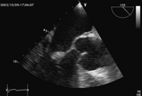 Transoesophageal echocardiogram, 120 degree view at mid oesophageal level. There is a small mobile mass seen at the tip of the anterior mitral valve leaflet. This oscillates independently to the valve, the hallmark of vegetation.