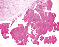 Histological section through the part of mitral leaflet. The vegetations appear to have a uniform eosinophilic appearance. There are no significant inflammatory cells and no microorganism visible.