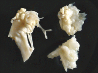 Large NBTE vegetations seen on the mitral valve leaflet. Only rarely are NBTE vegetations as extensive as these.