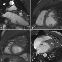 Cardiac magnetic resonance imaging (MRI) showing a large false aneurysm communicating with the left ventricle through a small neck which measures 10 mm × 7 mm. The left ventricular antero-lateral free wall is completely covered by a calcified shell (10 cm × 4 cm) forming the external layer of the false aneurysm. Left and right ventricular size and function were normal. Opening the cavity of the false aneurysm to get access to the neck was deemed prohibitively hazardous. Therefore a trans-mitral approach was elected. (A: two-chamber view, B and C: apical view; D: four-chamber view; FA: false aneurysm, LV: left ventricle, *: calcified shell).