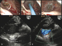 A left atriotomy was performed. Following the retraction of the anterior mitral leaflet and using a 60° angle scope, the neck of the false aneurysm was identified (A). Direct surgical repair was attempted without success because of (1) difficulty to reach the surgical site with long surgical instruments and (2) fragility of ventricular tissue at the inferior edge of the defect. These major technical challenges led us to apply a percutaneous occluder-device under video-assisted vision. A 12 mm Amplatzer septal occluder-device was placed under video-assisted vision across the neck of the false aneurysm with the left disk in the pseudoaneurysm and the right disk on the ventricular side (B and C). Transesophageal echocardiography showed a definite closure of the false aneurysm (D and E). The patient was discharged on postoperative day 7 and is doing well 2 months following the procedure. Surgical repair of FA using a patch is the appropriate treatment to prevent peripheral embolization, ventricular arrhythmia, and late rupture. Occasionally the surgical approach to the site of intervention can be complicated due to extensive calcification. In this scenario, a trans-mitral approach with the use of an occluder-device may be a valuable therapeutic alternative. In this case this procedure was performed easily under vision in a very short time. Currently occluder-devices are used with success for atrial septal defect repair and are not approved for such indications. Further studies with larger number of patients are required to determine their role in the treatment of FA as a ‘rescue therapy’ when conventional surgical treatment is unsuccessful. (A–C: intraoperative views; A: trans-mitral visualization of the false aneurysm (FA) using a 60° angle scope; B: delivery of Amplatzer occluder device, C: occluder device in place; D–E: intraoperative echocardiography; D: modified transgastric view; E: color Doppler; LV: left ventricle).