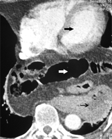 CT scan taken at a later date as outpatient confirming the presence of hiatus hernia. Black thick arrow, heart; black thin arrow, stomach; white thick arrow, loops of bowel.