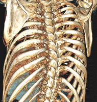 CT-scan of a patient with multiple pleuro-pulmonary collaterals.