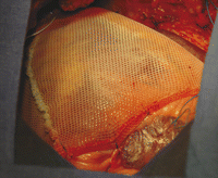 Intraoperative view of cardiac support device implantation.