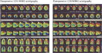 123I-MIBG single-photon emission computed tomography images. Data are reconstructed along the short axis, vertical long axis and horizontal long axis. The heterogeneity of the radiotracer’s distribution over the myocardial wall is observed on the preoperative exam especially in the septal area (white arrows) and is clearly improved on the postoperative exam (dotted white arrows).
