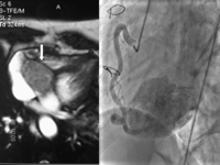 Cardiac MRI; white arrow indicates the paraganglioma, selected angiogram of right coronary artery.