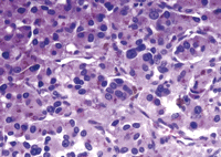 A photomicrograph of paraganglioma with large polygonal cells arranged in nests.
