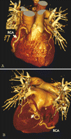 Mega-right coronary artery (RCA) (A) draining into the left ventricle (B) via the posterior myocardium (white arrow) is shown 3D with multislice computed tomography by applying volume-rendering technique (VRT).