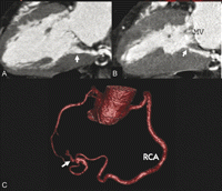Retrospective ECG-gated image reconstruction by multislice CT showed the fistula open during end-diastole (A) and narrowing of the inner fistula orifice during end-systole (B) due to compression by the myocardium. The inner fistula orifice is located close to the mitral valve (MV) annulus. The RCA had a tortuous ‘8-shaped’ course before its entrance into the left ventricle (white arrow) (C).