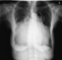 Chest X-ray shows massive cardiomegaly (cardiothoracic ratio = 1) with splaying of the carina.