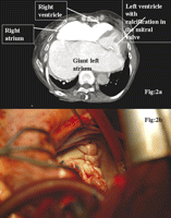(a) Contrast-enhanced CT scan shows gross enlargement of the left atrium filling the width of the thorax. (b) Intraoperative picture showing the bulky plication suture line of giant LA appendage from within the left atrium.