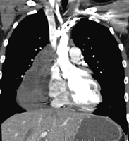 Example of giant benign teratoma in a 13-year-old girl: preoperative computed tomography.