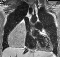 Giant benign teratoma in a 26-year-old female patient: preoperative MRI.