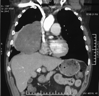 Large benign solitary fibrous tumour of the pleura: preoperative computed tomography.