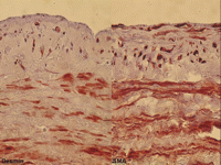 Immunohistochemical staining of paclitaxel (1 μmol/l) treated human saphenous veins after 2 weeks of organ culture. The desmin amount (left panel) is highest in the outer circumferential media and lower in the inner longitudinal media and intima. The SMA amount (right panel) is high in all layers of the vascular wall.