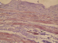 Immunohistochemical stain for ki-67 of a human saphenous vein after 2 weeks of organ culture without paclitaxel treatment (control group). Note the positive staining in the outer circumferential media (black arrow), whereas in the inner longitudinal media (marked by broken black arrow) and in the intima (white arrow) ki-67 positive cells were almost absent (40-fold magnification).