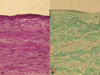 Elastica stain (A) of a human saphenous vein after storage in transportation medium without consecutive organ culture (baseline group). Elastic fibers are found in the whole vascular wall without differences between the groups. Panel B shows untreated human saphenous vein after 2 weeks of organ culture (control group). Collagen fibers (Masson’s trichrome stain, B) are predominately localized in the inner longitudinal media (only intensive green color is counted positive), to a less extent in the outer media. In the neointima that increased during organ culture (marked by black arrow) no collagen fibers are noted. (light green color does not count positively). For interpretation of the references to color in this figure legend, the reader is referred to the web version of the article.)