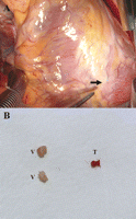 (A) The distal left anterior descending artery was totally occluded by septic embolic vegetations, which were located distal to the coronary incision and easily removed by pressing them out through the arterial wall; the thrombi located proximal to the vegetations were visualized as lesions with bluish discoloration (arrow). (B) Surgically removed embolic vegetations and a thrombus from the distal left anterior descending artery (V: vegetation; T: thrombus).