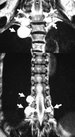 Composite picture of spinal MRI scan showing 8 lateral thoracic meningoceles (white arrows), 5 in the upper and 3 in the lower paravertebral area. Meningocele should be included in differential diagnosis of posterior mediastinal cysts. There are some reports of ruptured meningoceles in the literature. This patient was not admitted to hospital, the lesion was seen in a routine chest X-ray, confirmed with CT and diagnosed by MRI and she is being followed up for 3 years.