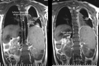 Coronal T2 weighted spin-echo image shows interrupted inferior vena cava with azygos continuation to the right of the abdominal aorta. Note the right-sided gastric camera and spleen.