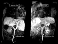 Early phase Angio-MRI with volume rendering 3D reconstruction (VR3D) performed after gadolinium injection in a peripheral left lower limb vein. Contrast material is delivered to the persistent hepatic venous plexus (PHVP) through a spontaneous cavo-portal fistula.