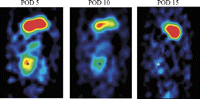 Micro-SPECT antero–posterior view of the abdomen of the same animal showing the transplanted heart on POD 5 (left), 10 (middle) and 15 (right) after Ad-NIS perfusion. The hot spot corresponds to the position of the transplanted heart (*). The hot spot above the transplanted heart corresponds to the 123I concentration in the stomach due to the inherent presence of NIS in the gastric mucosa. The regions of interest were defined manually around the heart shadows on the reconstructed axial tomographic images in all sections in which the heart was visualized, and quantification performed on the co-registered micro-SPECT images. This ensured accurate coregistration of the axial CT images with the micro-SPECT maps.